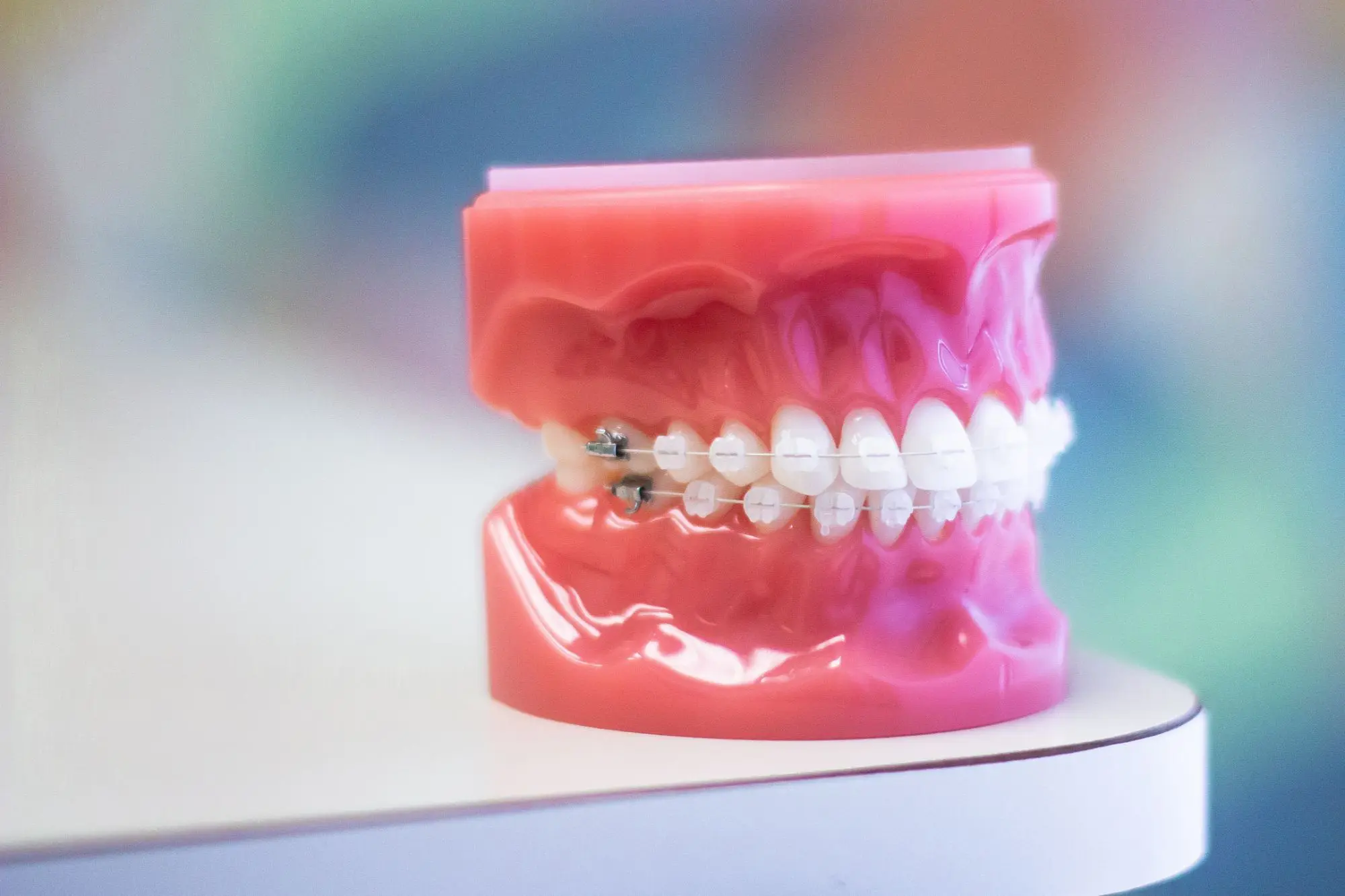 Clear braces offer a discreet, effective alternative to metal braces for a confident smile in Charlotte, Indian Trail, and Monroe NC.