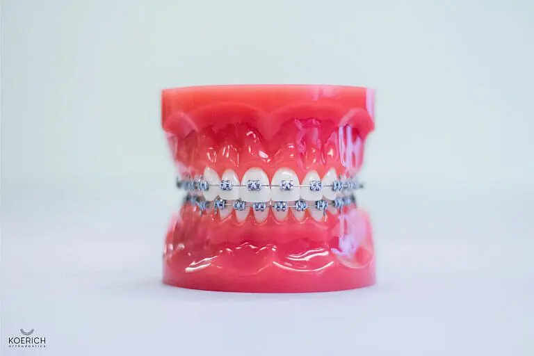 A dental model displays teeth fitted with metal braces, ideal for anyone seeking an orthodontist in Indian Trail, set against a plain background in Indian Trail NC