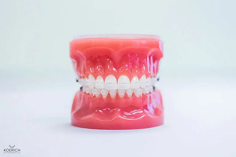 Orthodontic braces on a dental model are showcased against a plain background, highlighting the intricate work of an Orthodontist in Indian Trail NC
