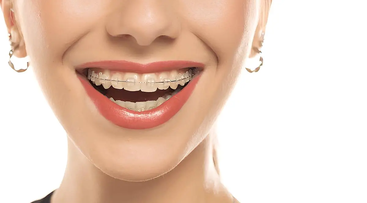 Woman smiling brightly, showcasing her clear braces as they enhance her radiant smile, wearing chic hoop earrings in Charlotte, NC