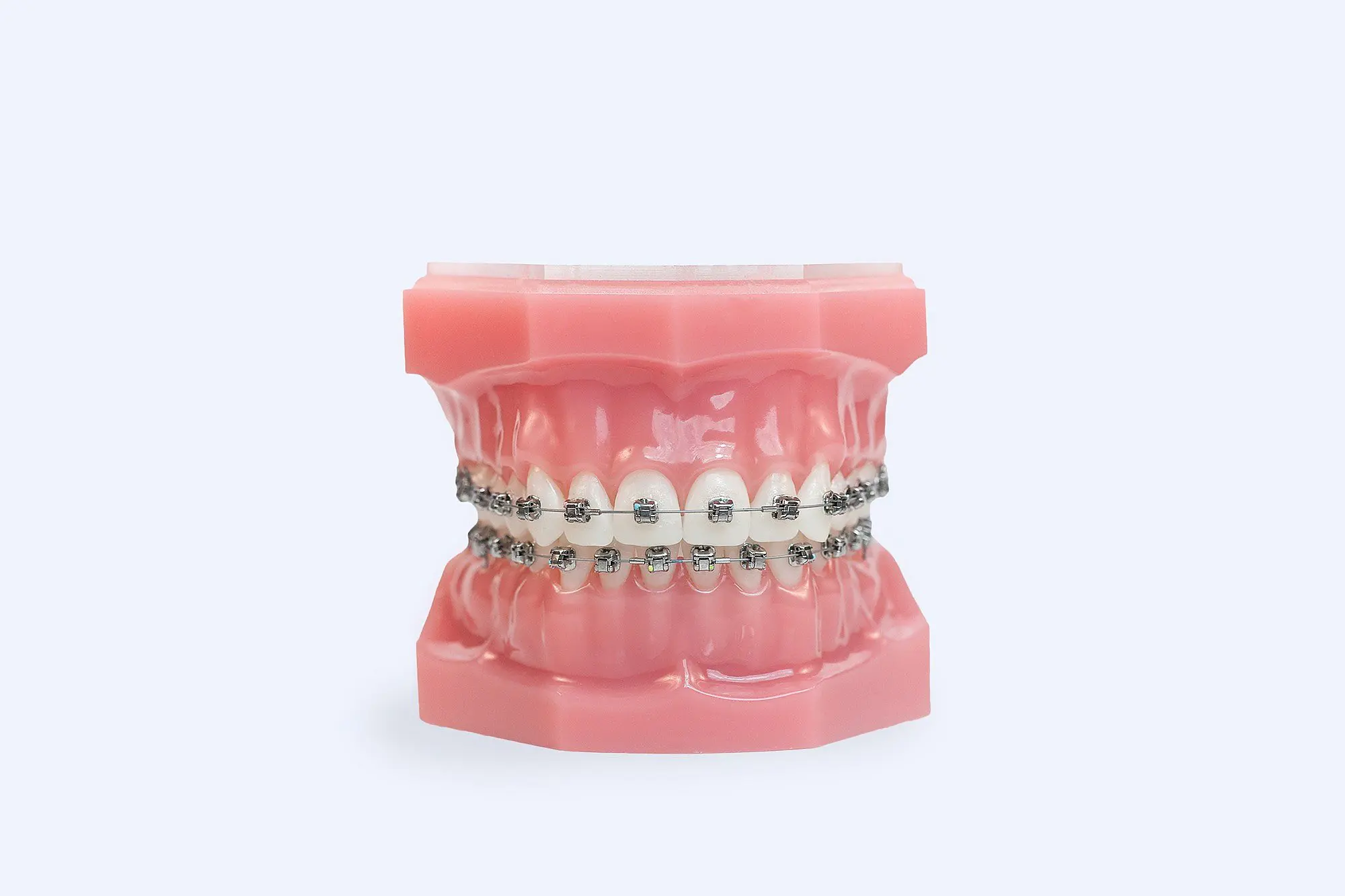 Traditional Metal Braces model displaying durable stainless steel brackets for effective orthodontic treatment in Charlotte, Indian Trail, and Monroe NC.