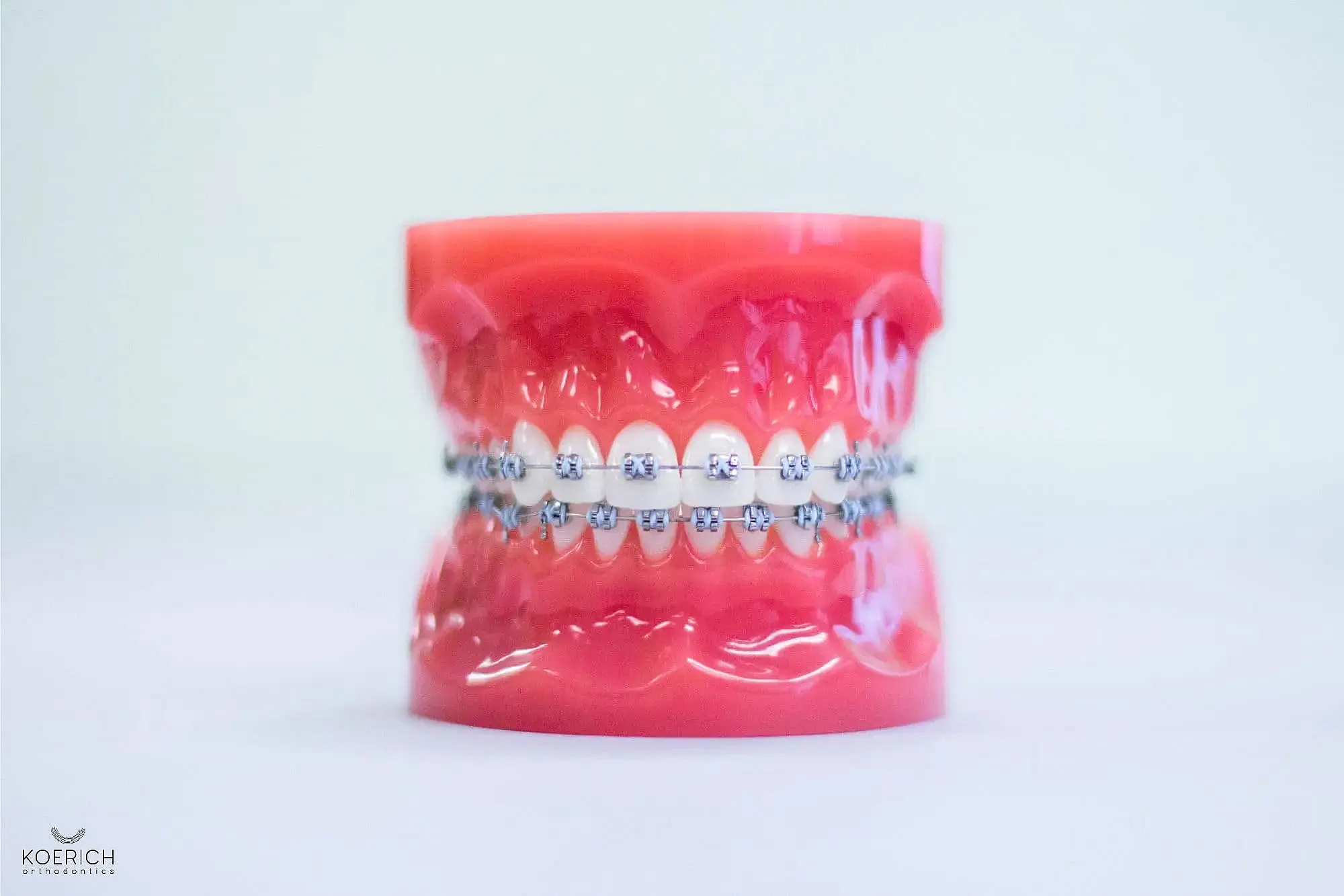 A dental model displays teeth fitted with metal braces, ideal for anyone seeking an orthodontist in Charlotte, set against a plain background in Charlotte NC