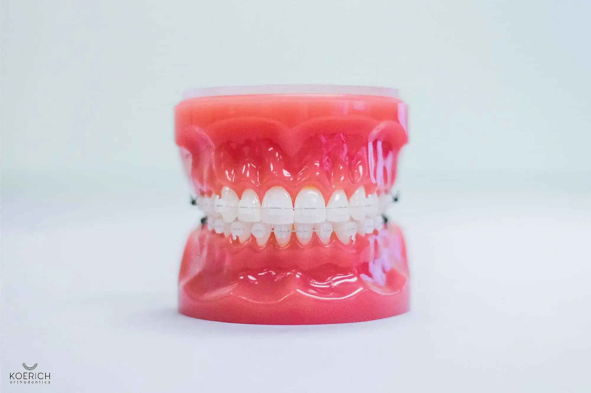 Orthodontic clear braces on a dental model are showcased against a plain background, highlighting the intricate work of an Orthodontist in Charlotte NC.