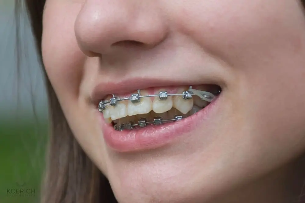 A close-up shows a person with metal braces and elastic bands on their teeth, smiling slightly—a typical result for patients at Koerich Orthodontics' braces for overbite in Charlotte, Indian Trail, or Monroe, NC.