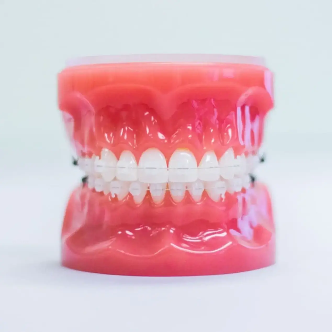 A dental model shows upper and lower teeth fitted with clear braces on both arches, photographed against a plain background at Koerich Orthodontics in Charlotte, Indian Trail or Monroe, NC.