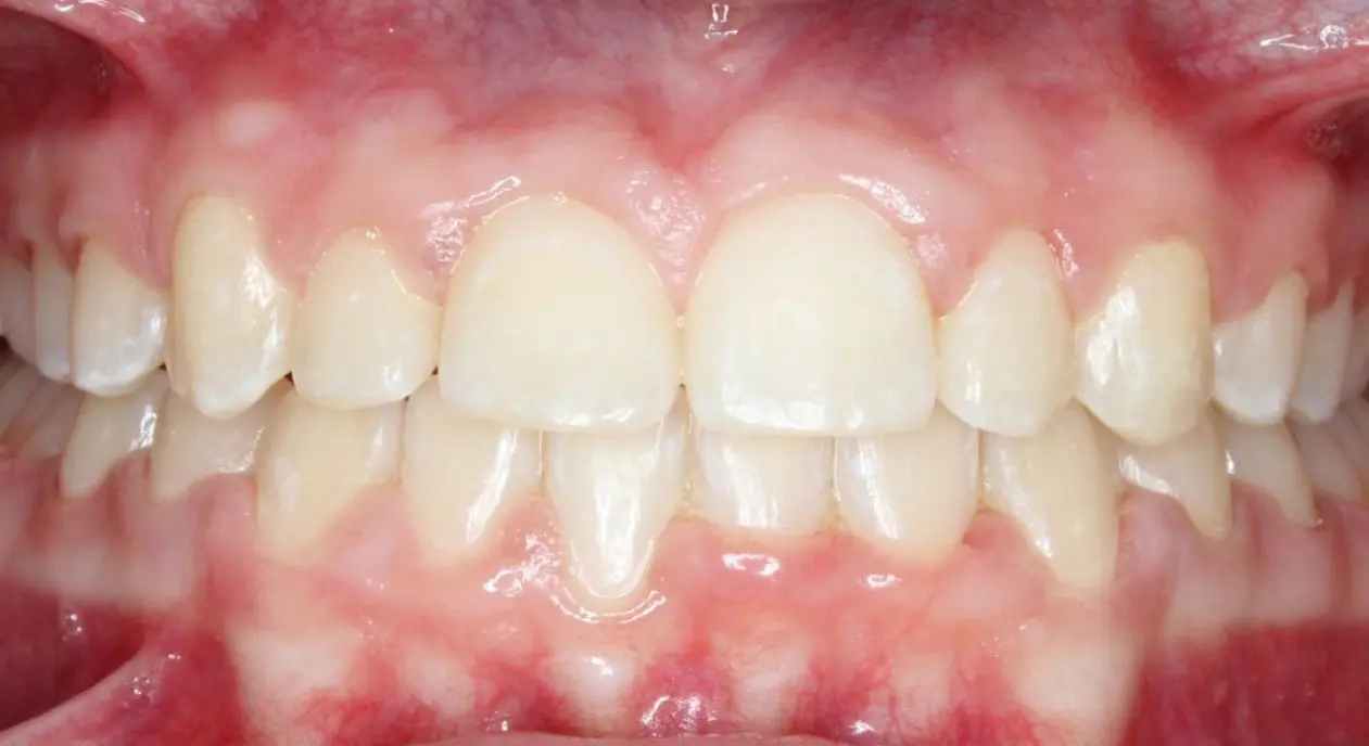 Close-up of mildly crowded, overlapping teeth and gums at Koerich Orthodontics in Charlotte, Indian Trail or Monroe, NC.
