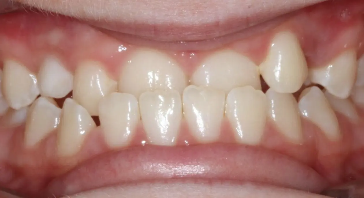 A close-up of misaligned teeth with crowding and an overbite at Koerich Orthodontics in Charlotte, Indian Trail or Monroe, NC.