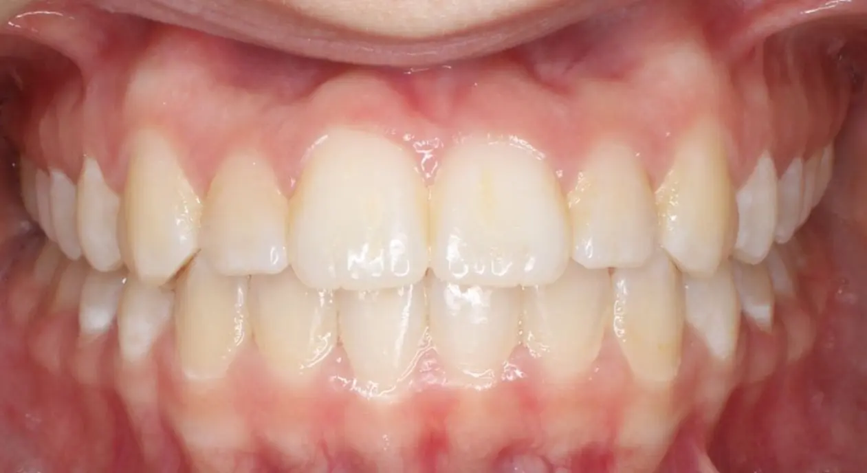 Close-up of clean, aligned adult teeth and healthy gums at Koerich Orthodontics in Charlotte, Indian Trail or Monroe, NC.