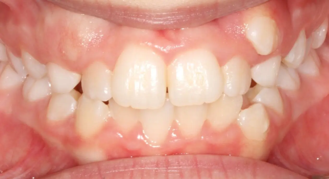 Misaligned, crowded teeth in upper and lower jaws treated by Koerich Orthodontics in Charlotte, Indian Trail or Monroe, NC.