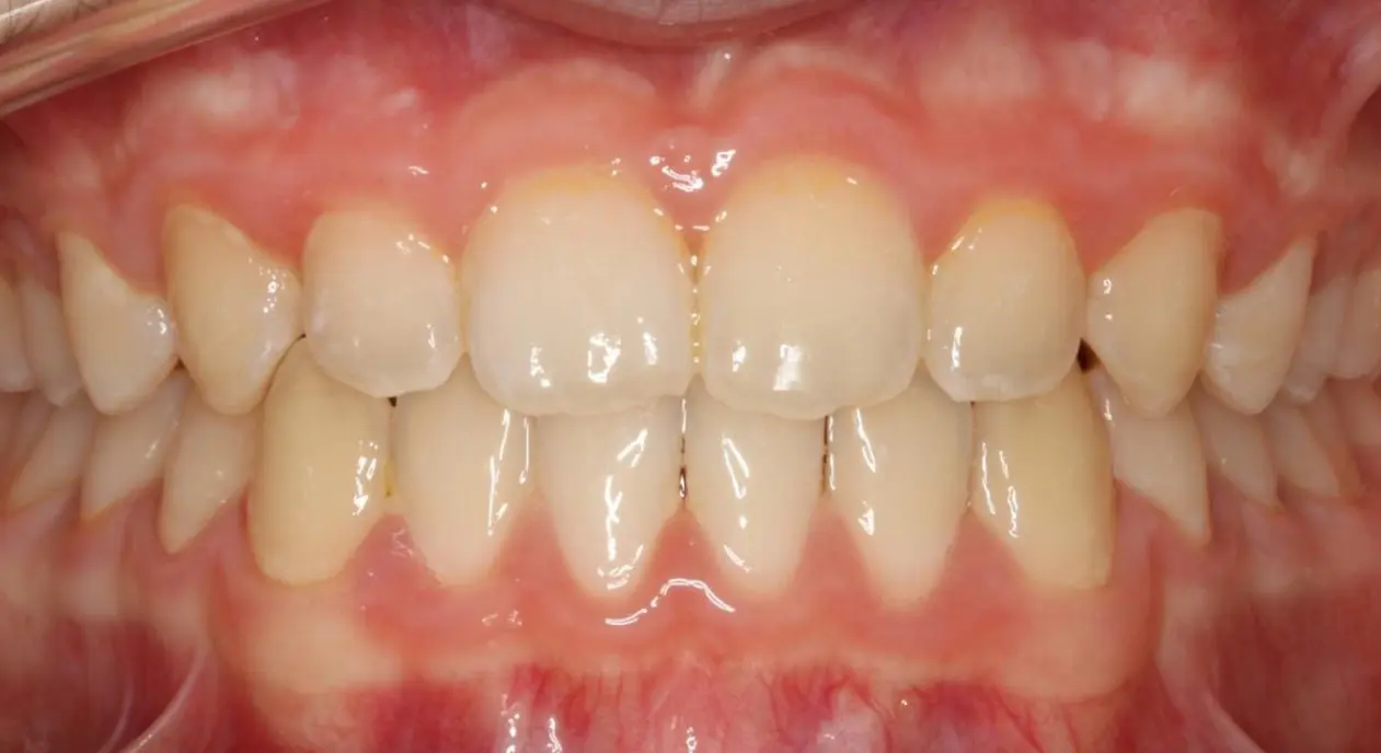 At Koerich Orthodontics in Charlotte, Indian Trail or Monroe, NC, teeth and gums with mild crowding are exposed by cheek retractors.