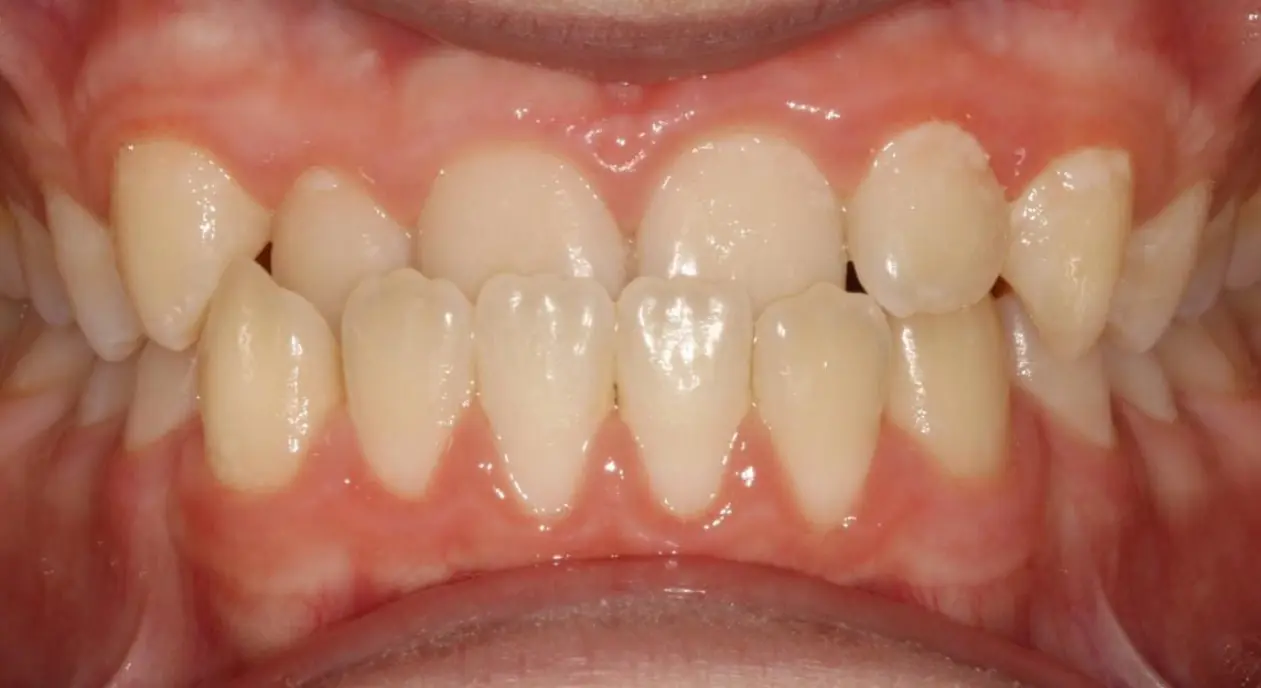 Mild teeth crowding and misalignment shown in a close-up at Koerich Orthodontics in Charlotte, Indian Trail or Monroe, NC.