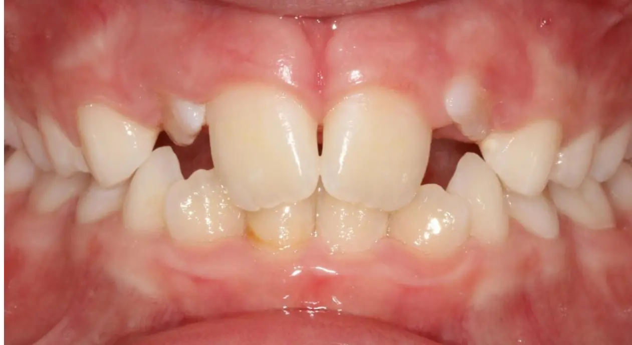 At Koerich Orthodontics in Charlotte, Indian Trail or Monroe, NC: close-up of crowded, misaligned teeth and visible gums.