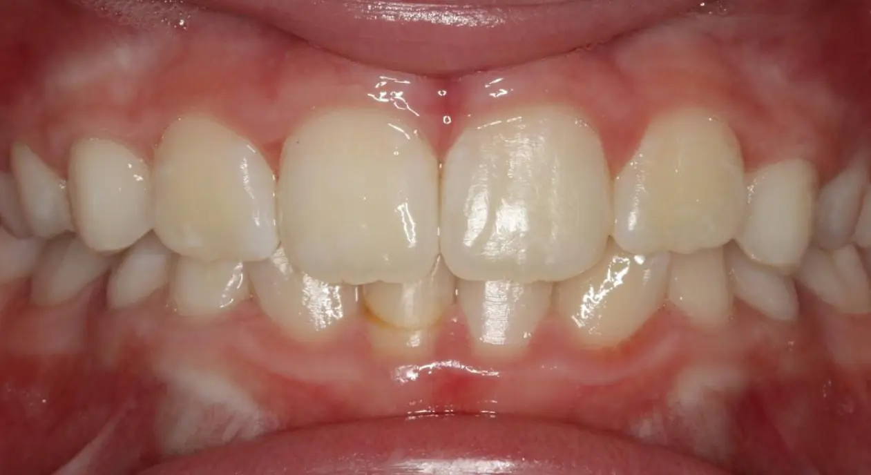 Mild teeth crowding, slight gaps, and plaque buildup shown—treated by Koerich Orthodontics in Charlotte, Indian Trail or Monroe, NC.