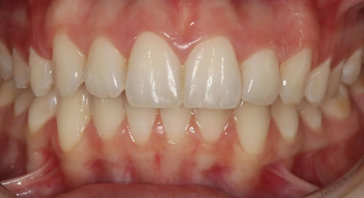 Clean, aligned teeth and healthy gums at Koerich Orthodontics in Charlotte, Indian Trail or Monroe, NC; no dental work visible.