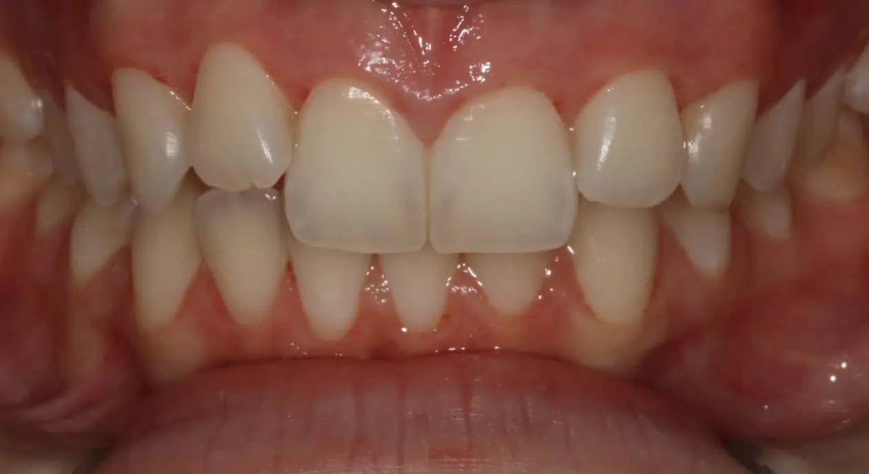 A close-up of healthy teeth and gums, as seen at Koerich Orthodontics in Charlotte, Indian Trail or Monroe, NC.
