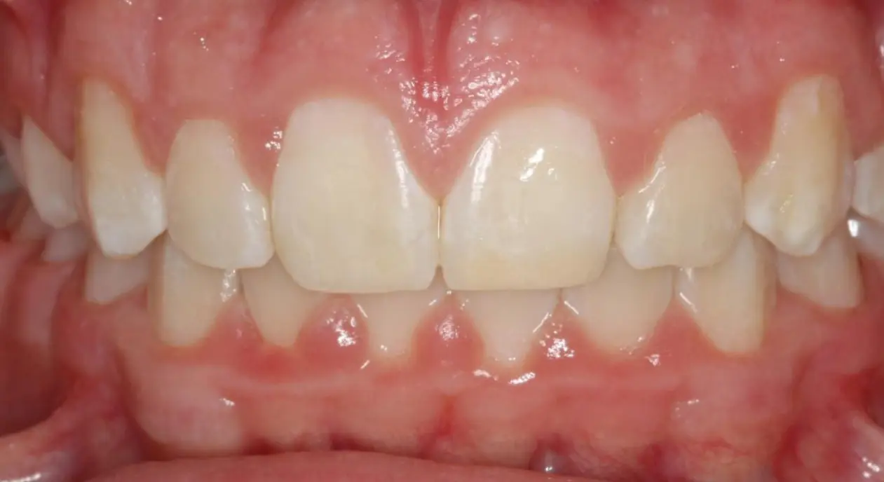 Slightly crowded lower front teeth with healthy gums at Koerich Orthodontics in Charlotte, Indian Trail or Monroe, NC.
