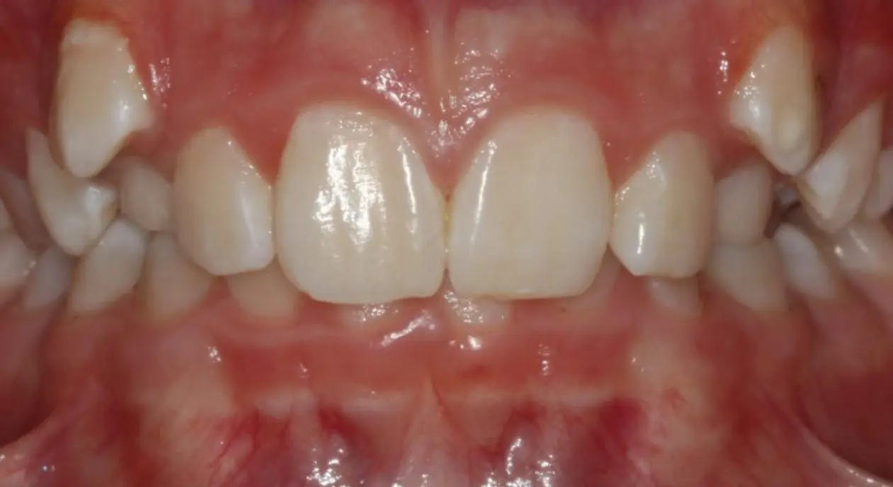 Close-up of a person's teeth at Koerich Orthodontics in Charlotte, Indian Trail or Monroe, NC.
