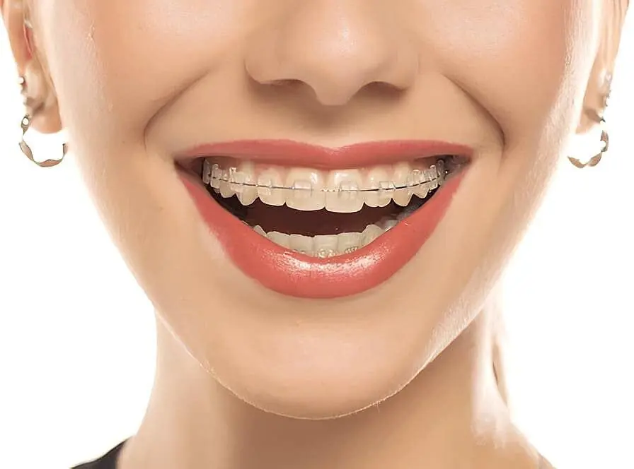 Woman smiling brightly, showcasing her clear braces as they enhance her radiant smile, wearing chic hoop earrings in Charlotte, NC
